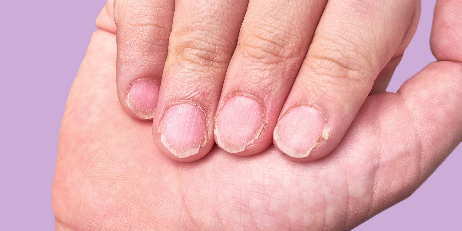 5 of the most common nail diseases