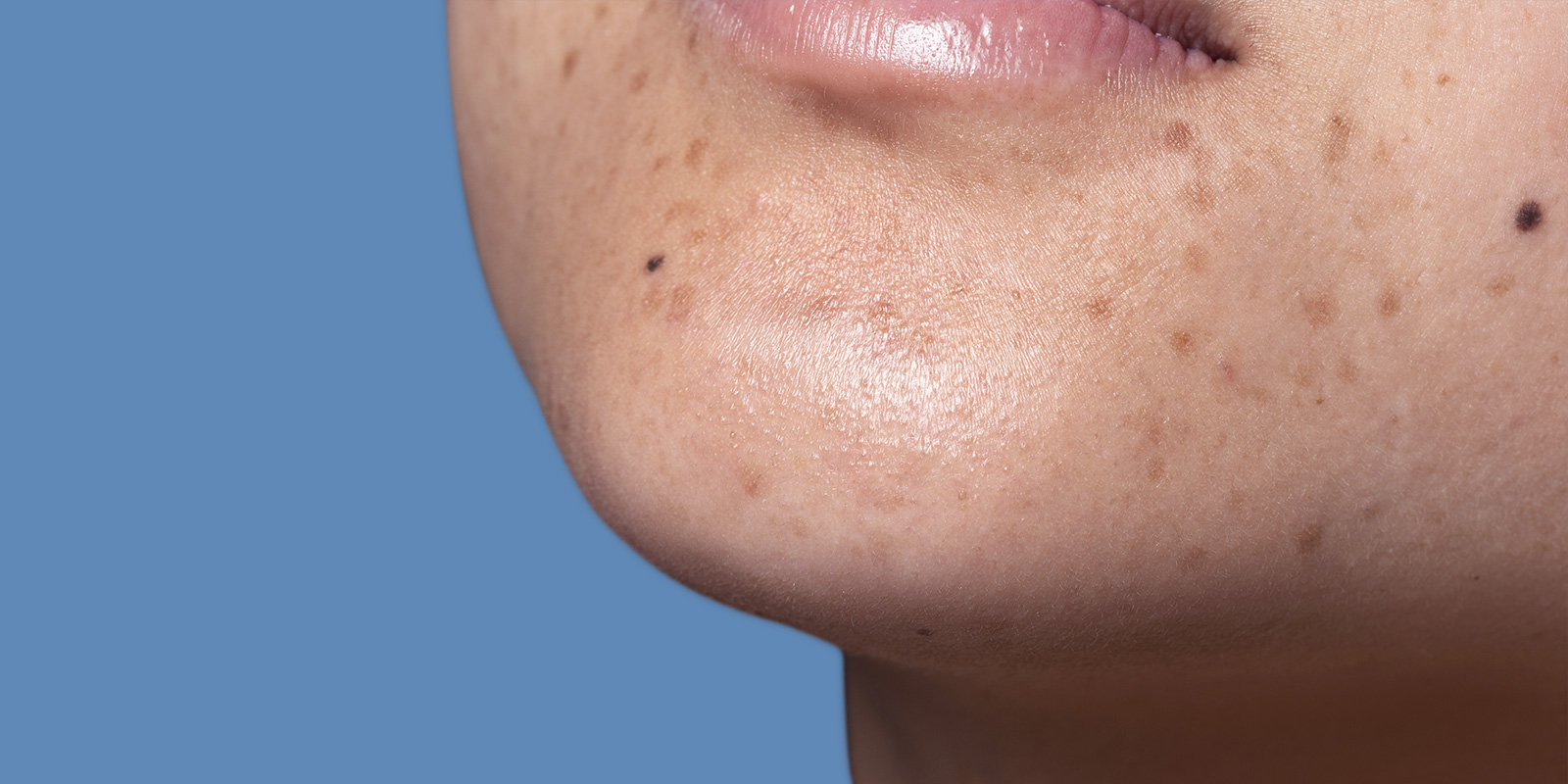 Dark spots: Learn about the causes, treatment, and prevention methods