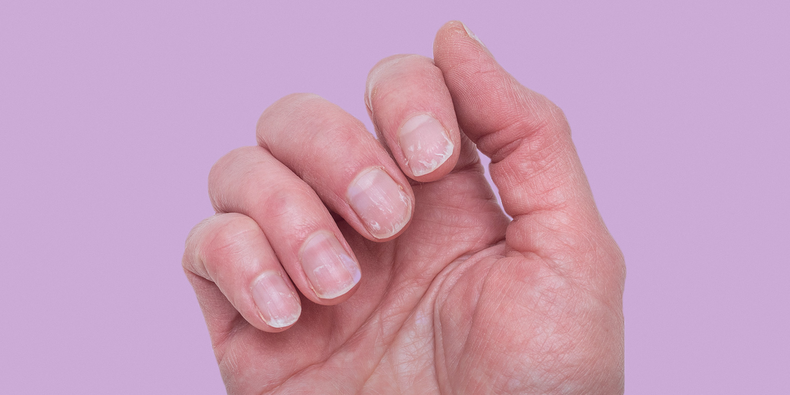 Weak nails: Causes and ways to prevent this common problem