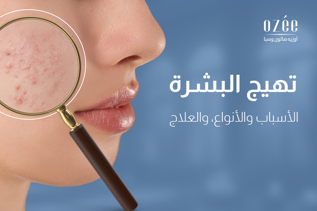 Skin Irritation: Causes, Types, and Treatment