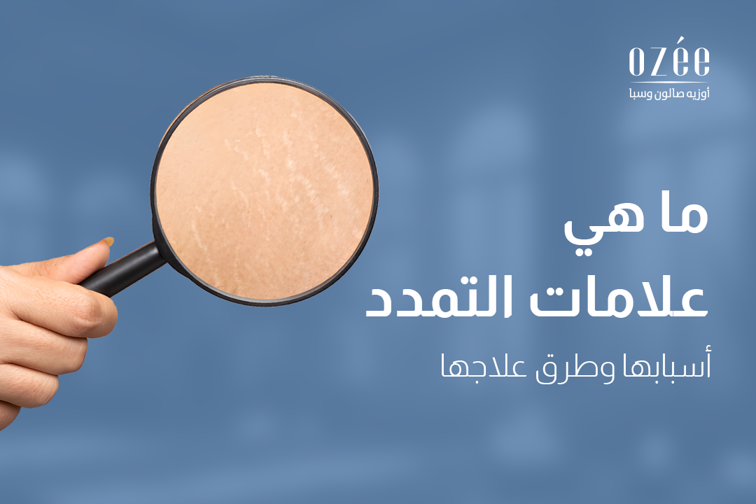 What Are Stretch Marks: Causes and Treatment Methods